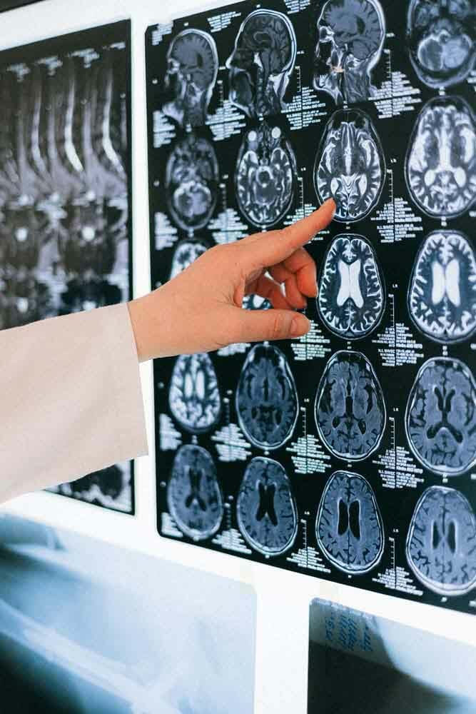 Le scanner d'un cerveau humain après les effets du cbd